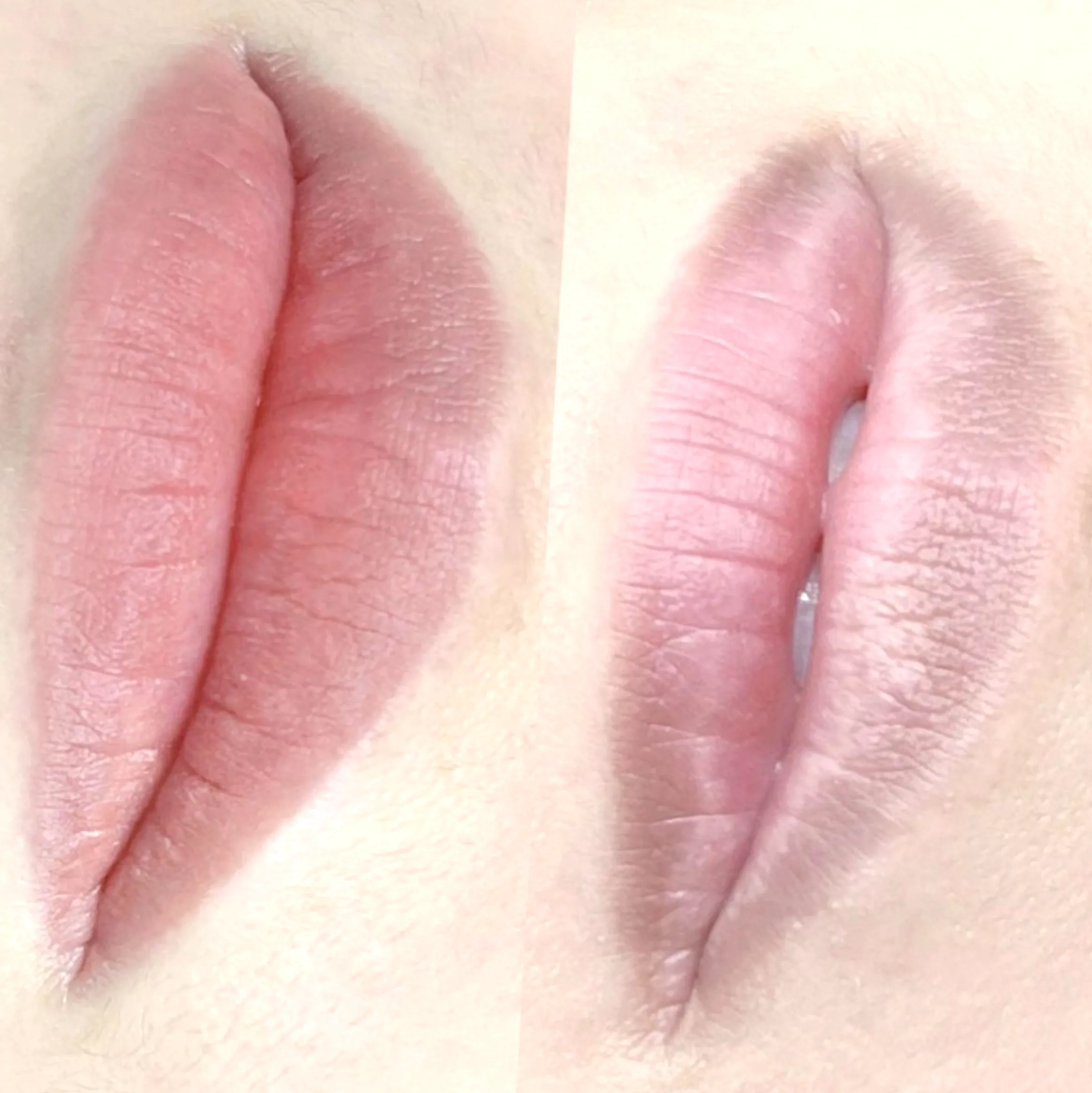dark lip neutralisation