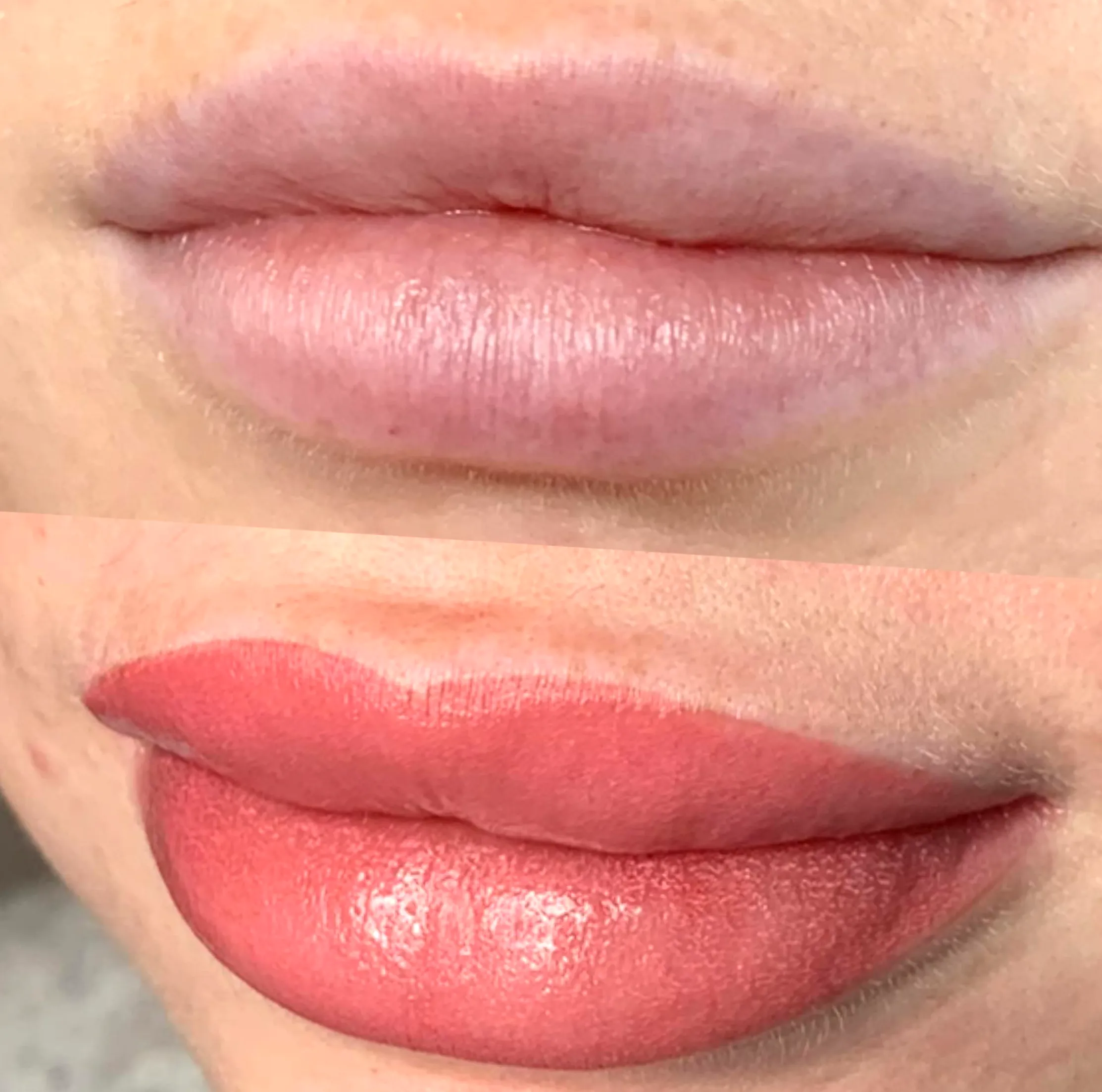 laser lip tattoo removal